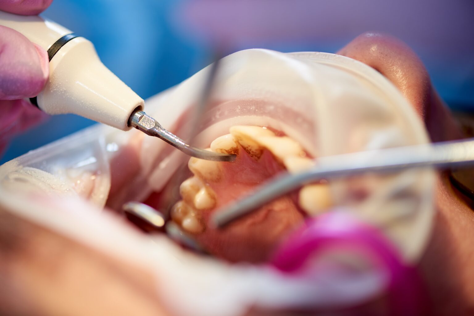 Composite Fillings in Laurel, MD