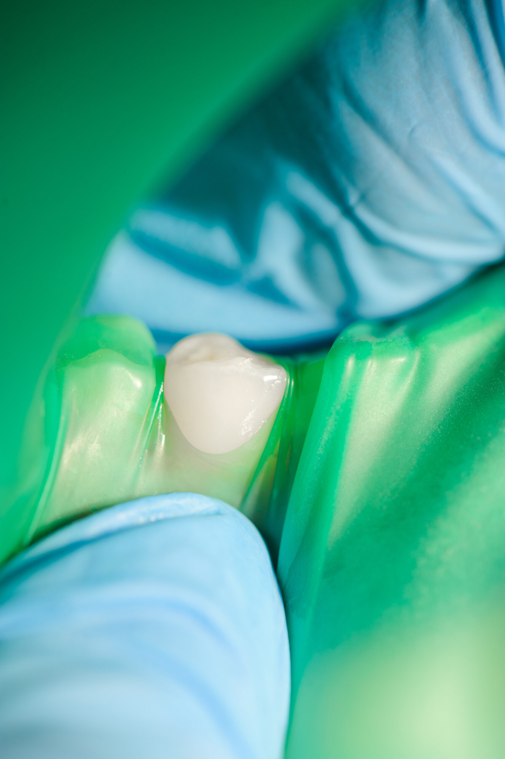 Porcelain / Zirconia Crowns in Laurel, MD