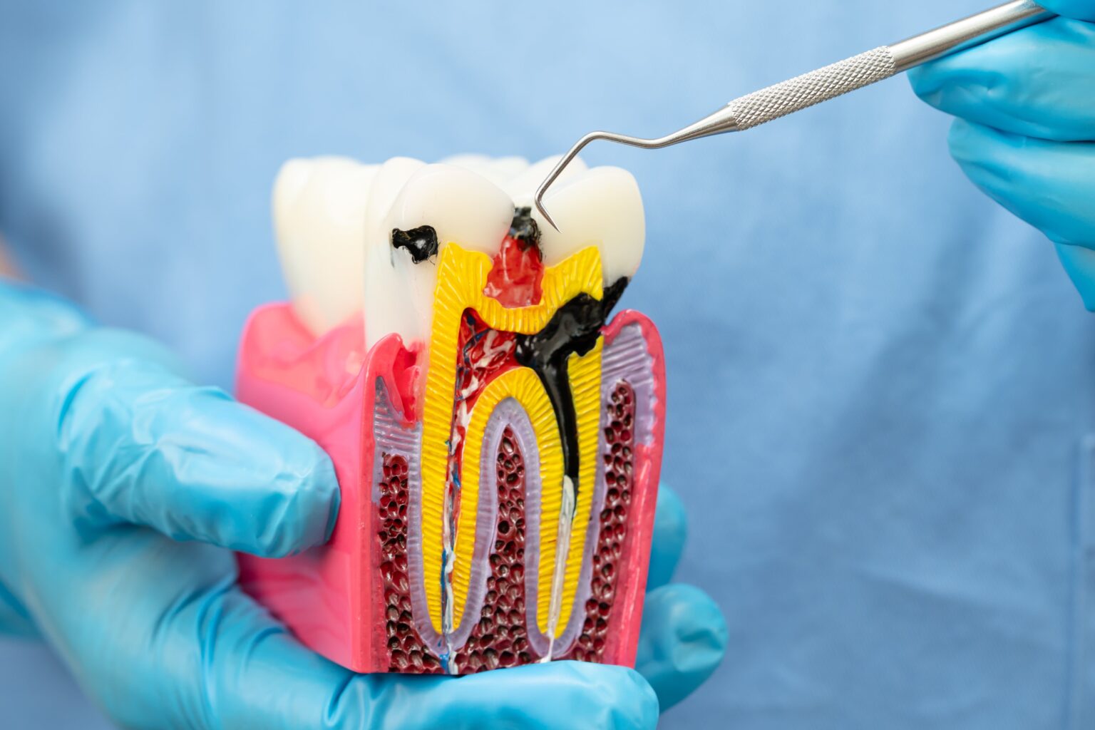 Root Canal Treatment in Laurel, MD Root Canal Treatment in Laurel, MD